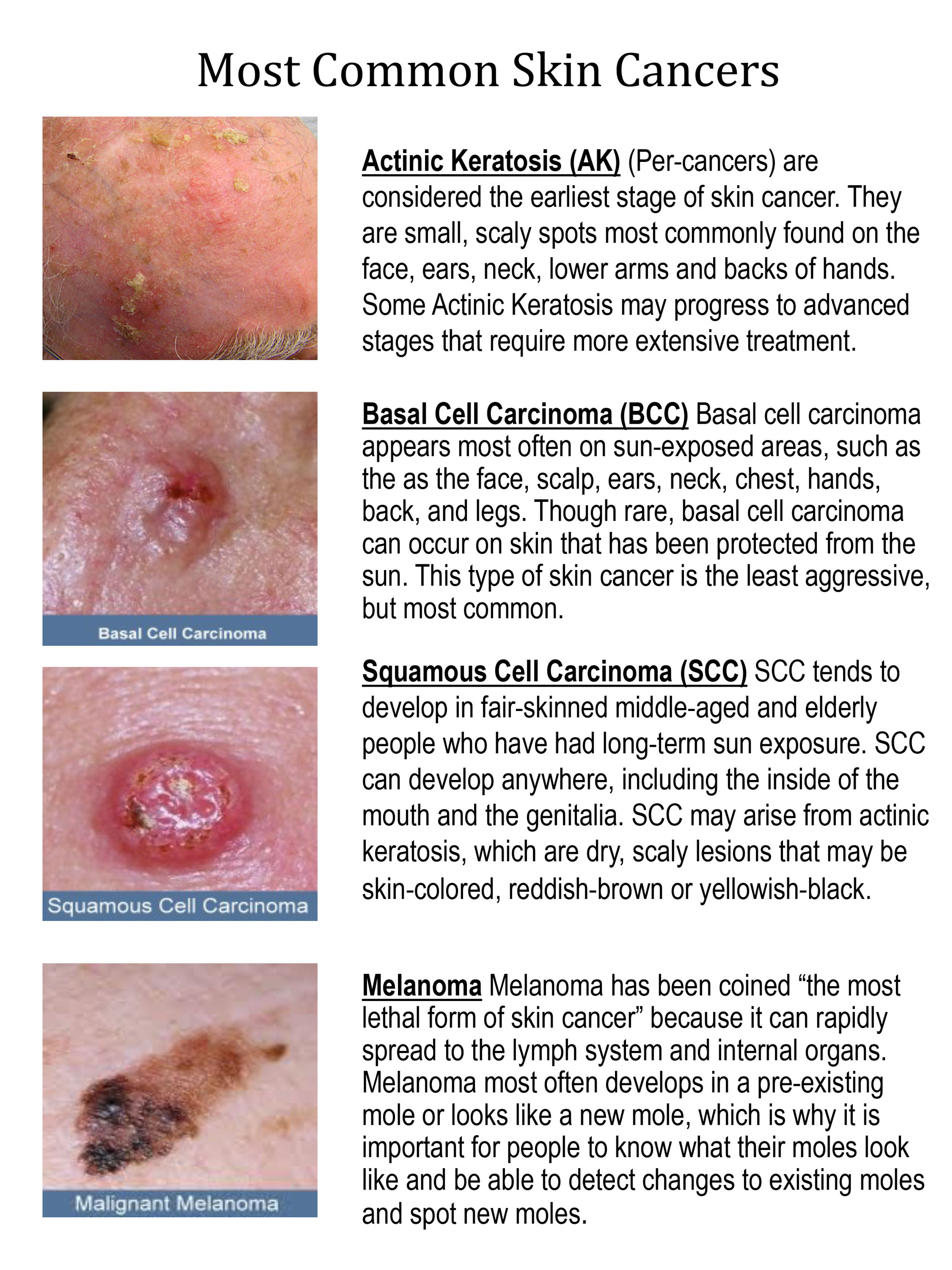 Most Common Skin Cancers 
