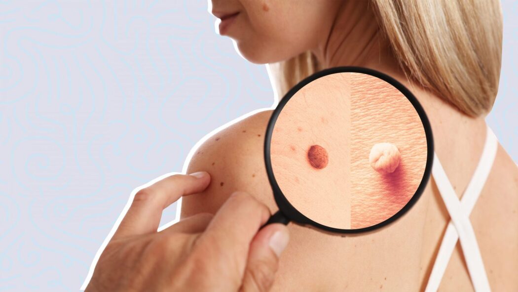 what-to-do-about-skin-tags-moles-and-other-lesions-genesis-dermatology