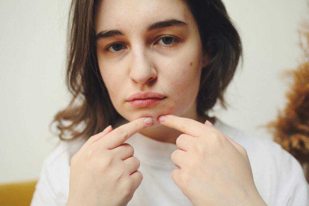 adult acne on jawline hormonal acne treatment options